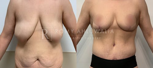 Before & After Result of Breast Reduction Patient #57