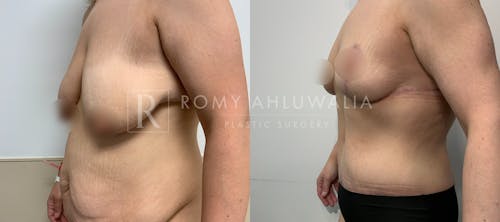 Before & After Result of Breast Reduction Patient #57
