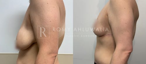 Before & After Result of Breast Reduction Patient #57