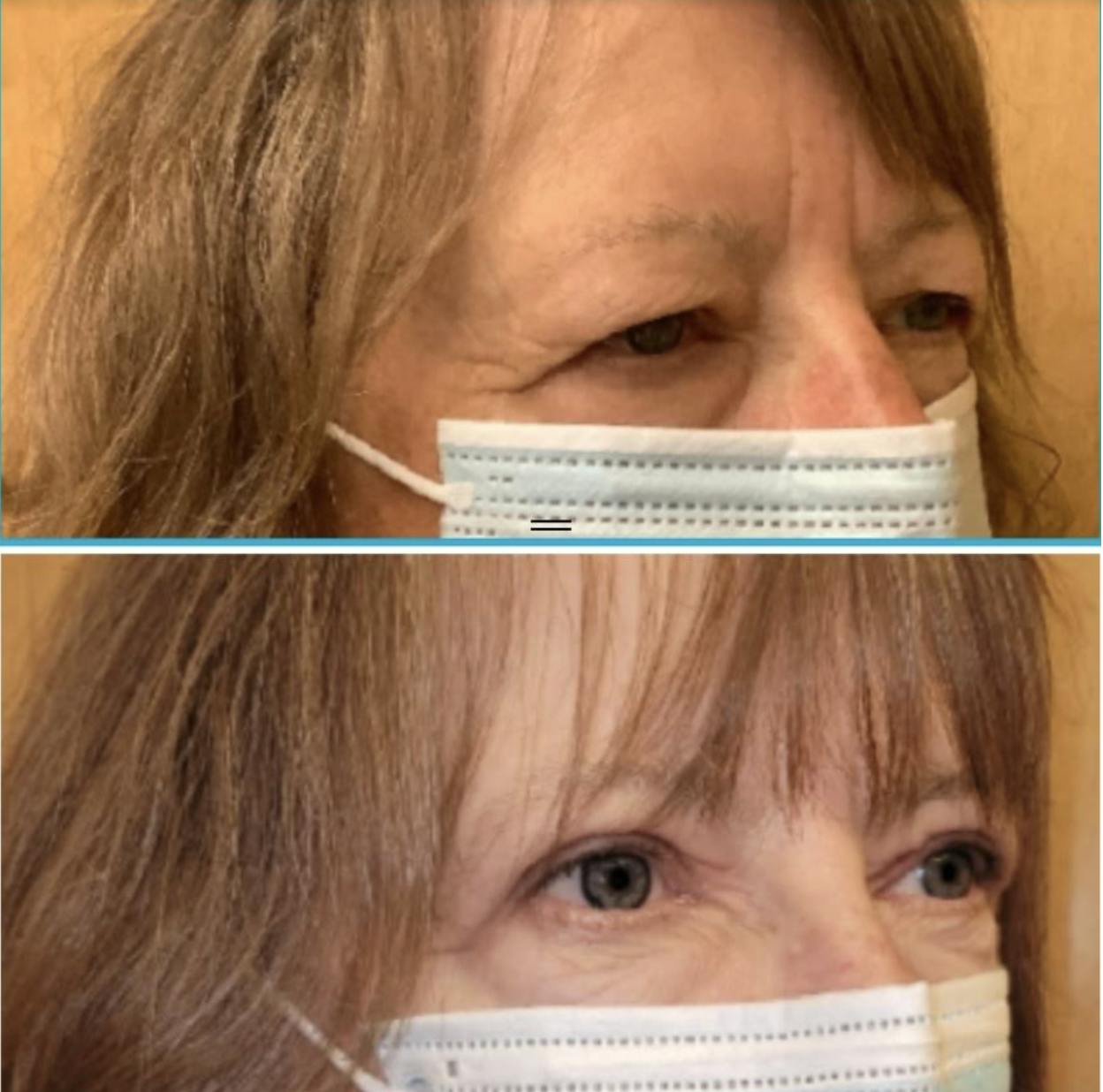 Upper Blepharoplasty Before & After Gallery - Patient 65915926 - Image 3
