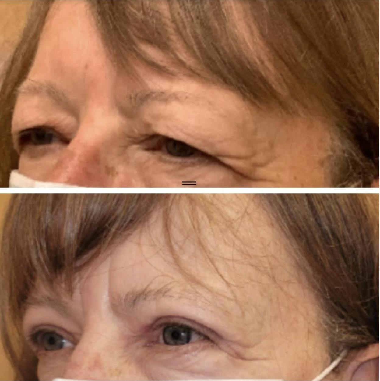 Upper Blepharoplasty Before & After Gallery - Patient 65915926 - Image 2