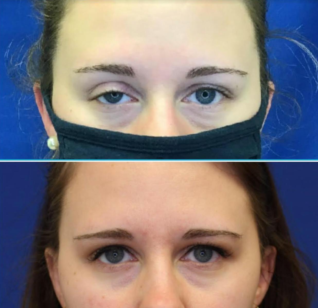 Ptosis Repair Before & After Gallery - Patient 65836095 - Image 1