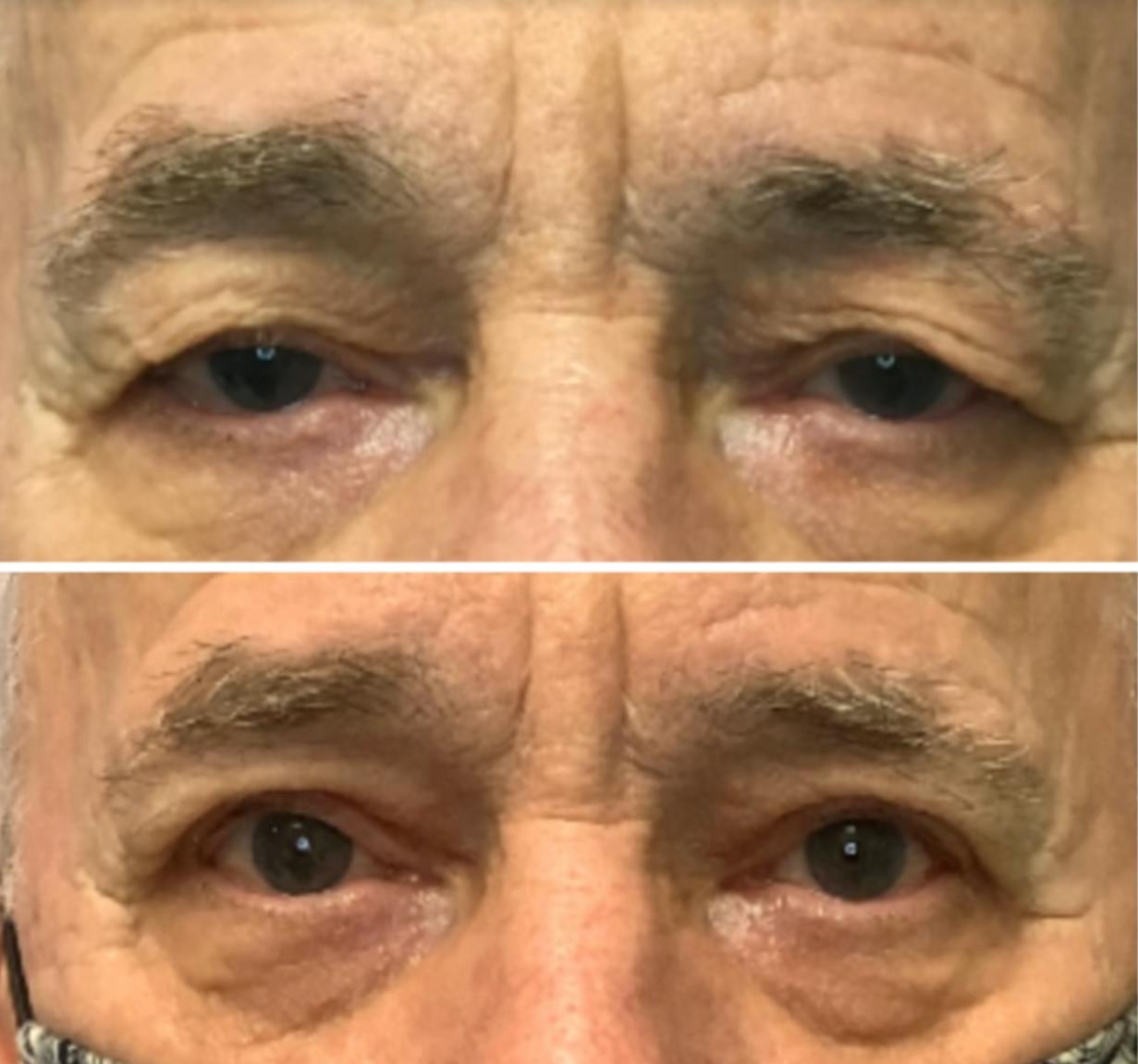 Ptosis Repair Before & After Gallery - Patient 65915897 - Image 1