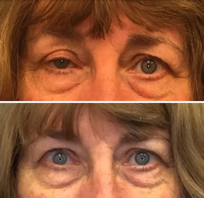 Ptosis Repair Before & After Gallery - Patient 65915910 - Image 1