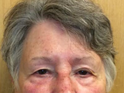 Ptosis Repair Before & After Gallery - Patient 65915914 - Image 1