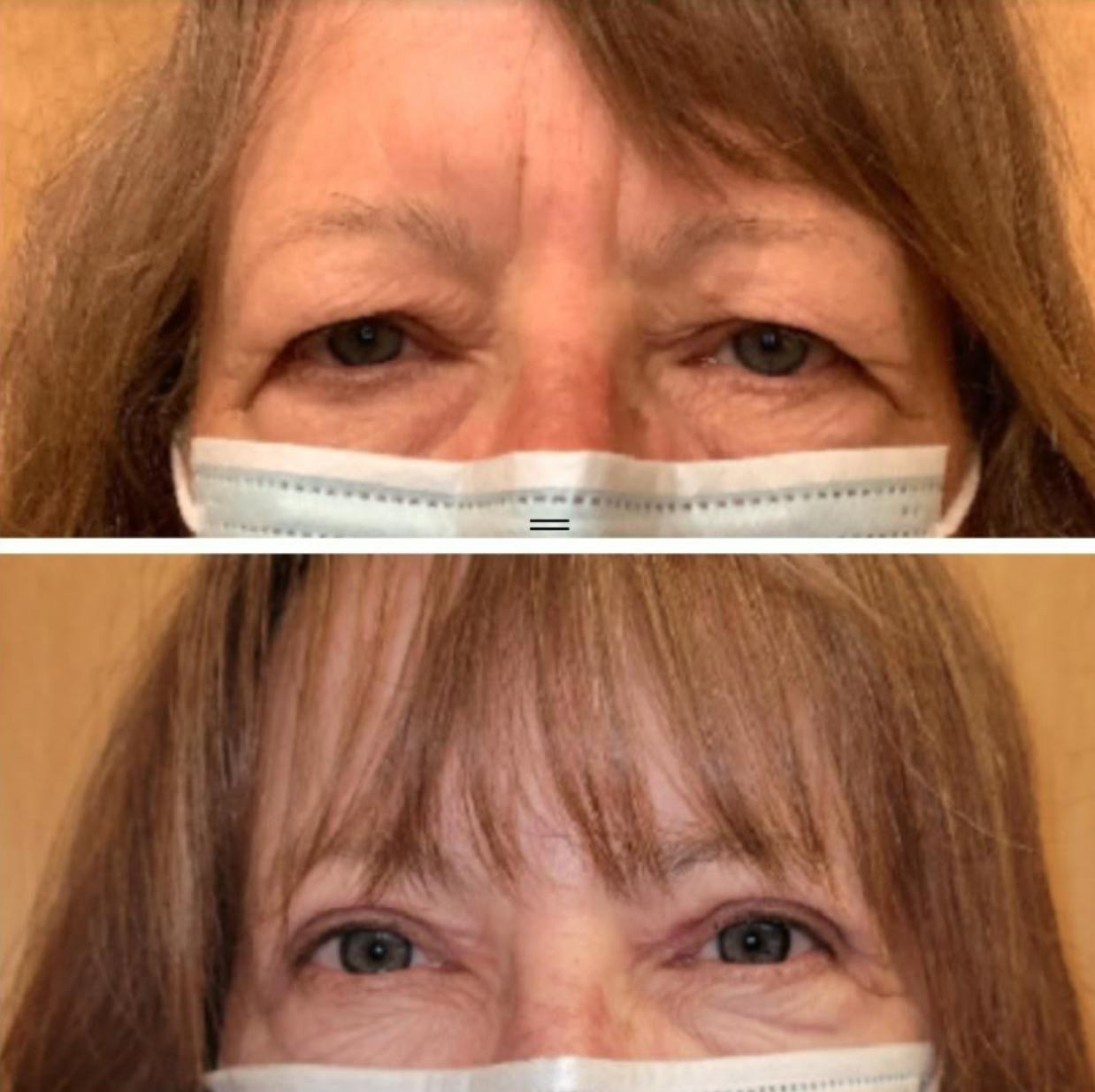 Upper Blepharoplasty Before & After Gallery - Patient 65915926 - Image 1