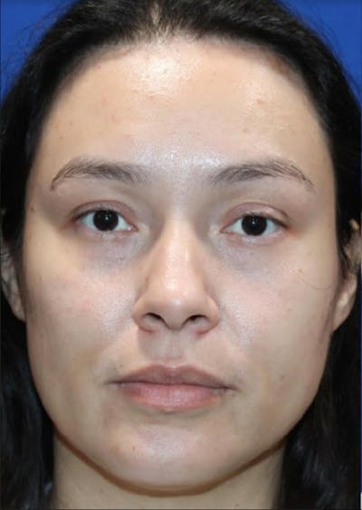 Nonsurgical Rejuvenation Before & After Gallery - Patient 77849561 - Image 1