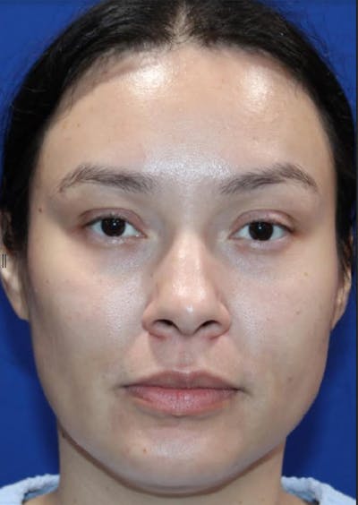 Nonsurgical Rejuvenation Before & After Gallery - Patient 77849561 - Image 2
