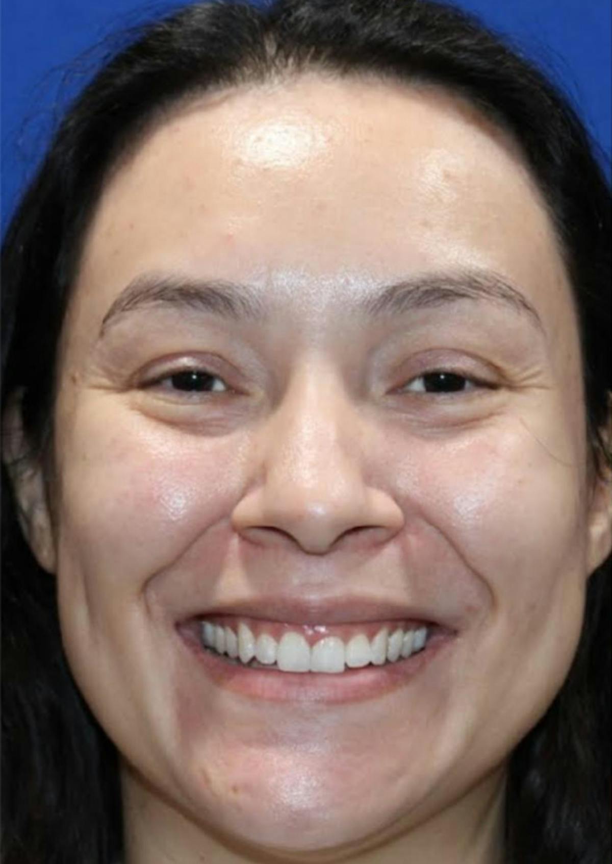 Nonsurgical Rejuvenation Before & After Gallery - Patient 77849561 - Image 3