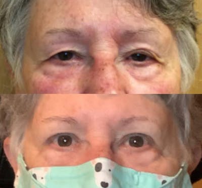 Upper Blepharoplasty Before & After Gallery - Patient 65915915 - Image 1