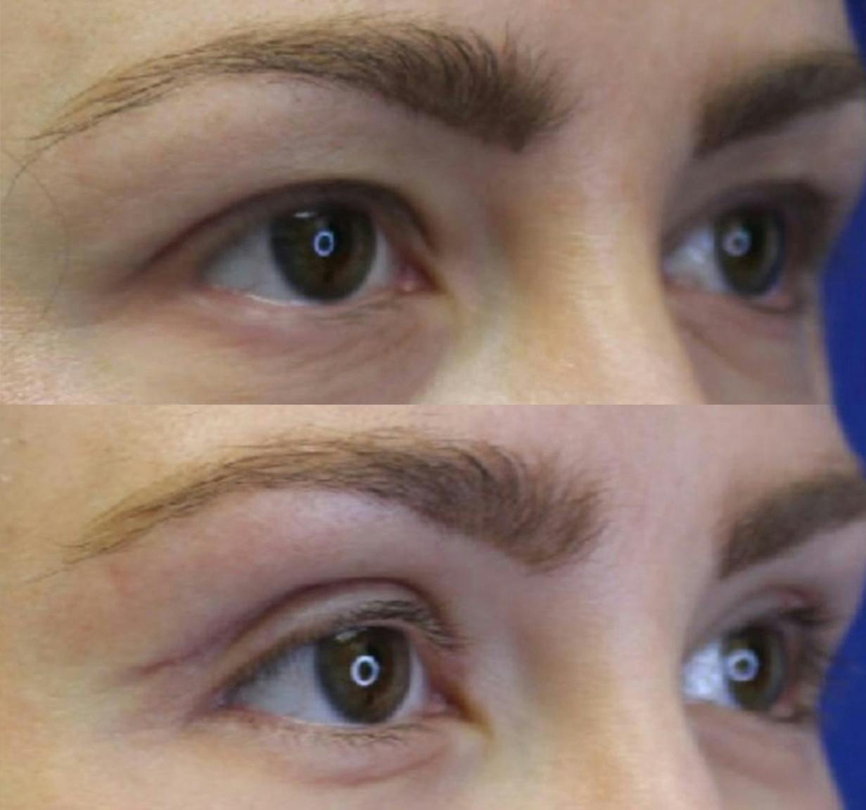 Upper Blepharoplasty Before & After Gallery - Patient 50776445 - Image 1