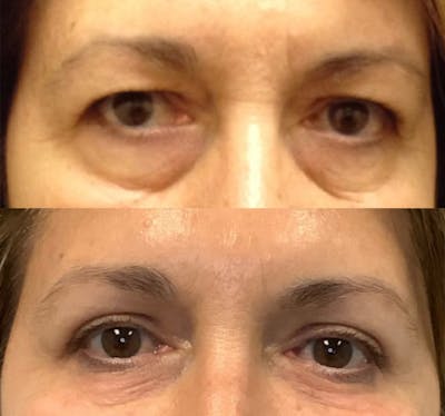 Lower Blepharoplasty Before & After Gallery - Patient 50776468 - Image 1