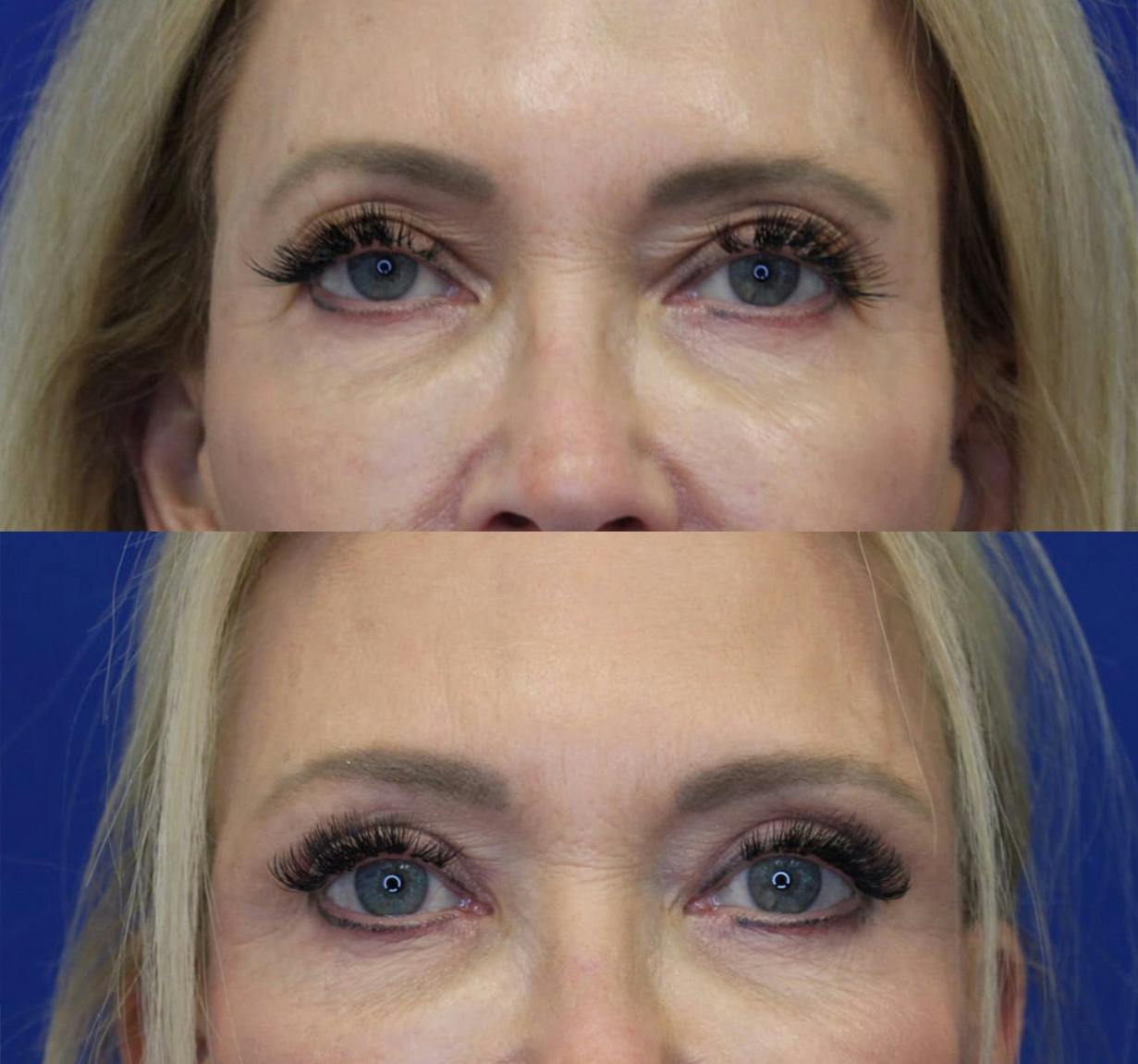 Upper Blepharoplasty Before & After Gallery - Patient 50776436 - Image 1