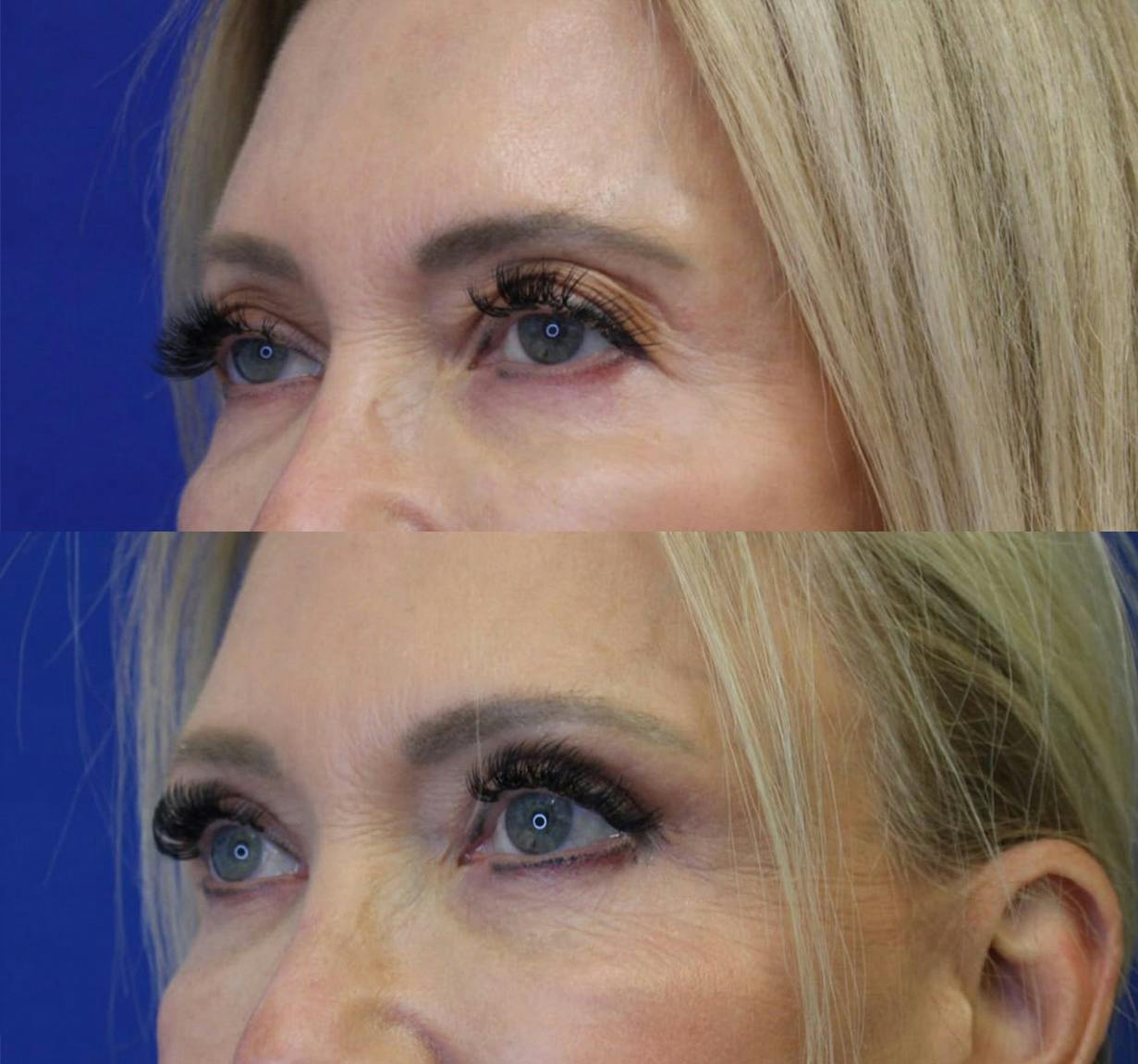 Upper Blepharoplasty Before & After Gallery - Patient 50776436 - Image 2