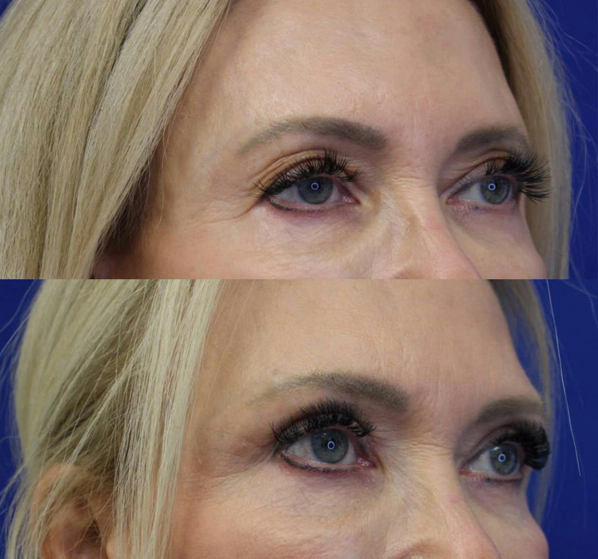 Upper Blepharoplasty Before & After Gallery - Patient 50776436 - Image 3