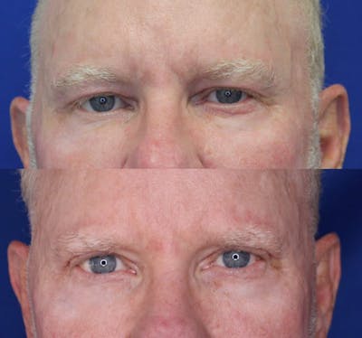 Upper Blepharoplasty Before & After Gallery - Patient 50776435 - Image 1