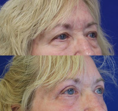 Upper Blepharoplasty Before & After Gallery - Patient 50776384 - Image 1