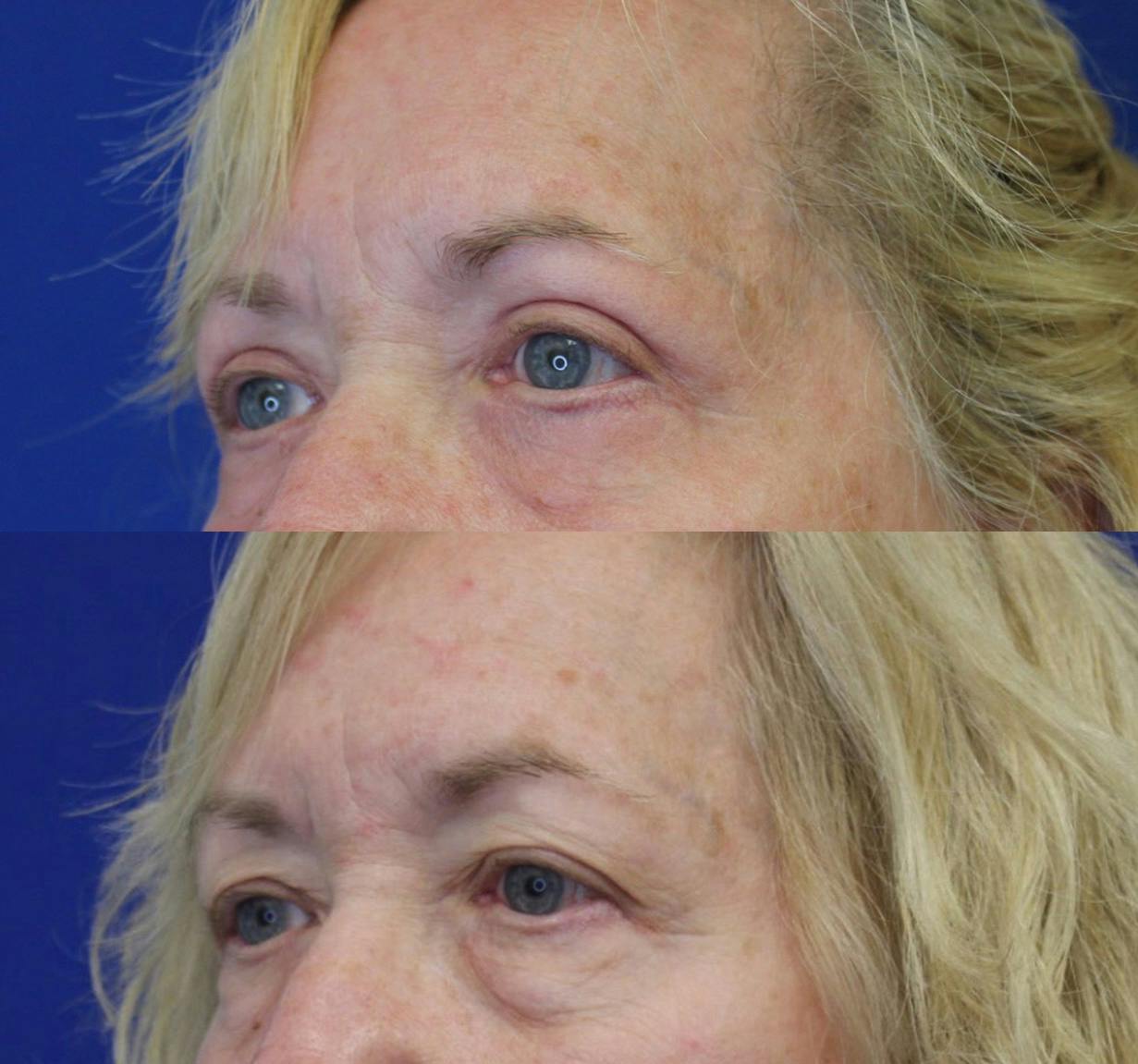 Lower Blepharoplasty Before & After Gallery - Patient 50776452 - Image 2