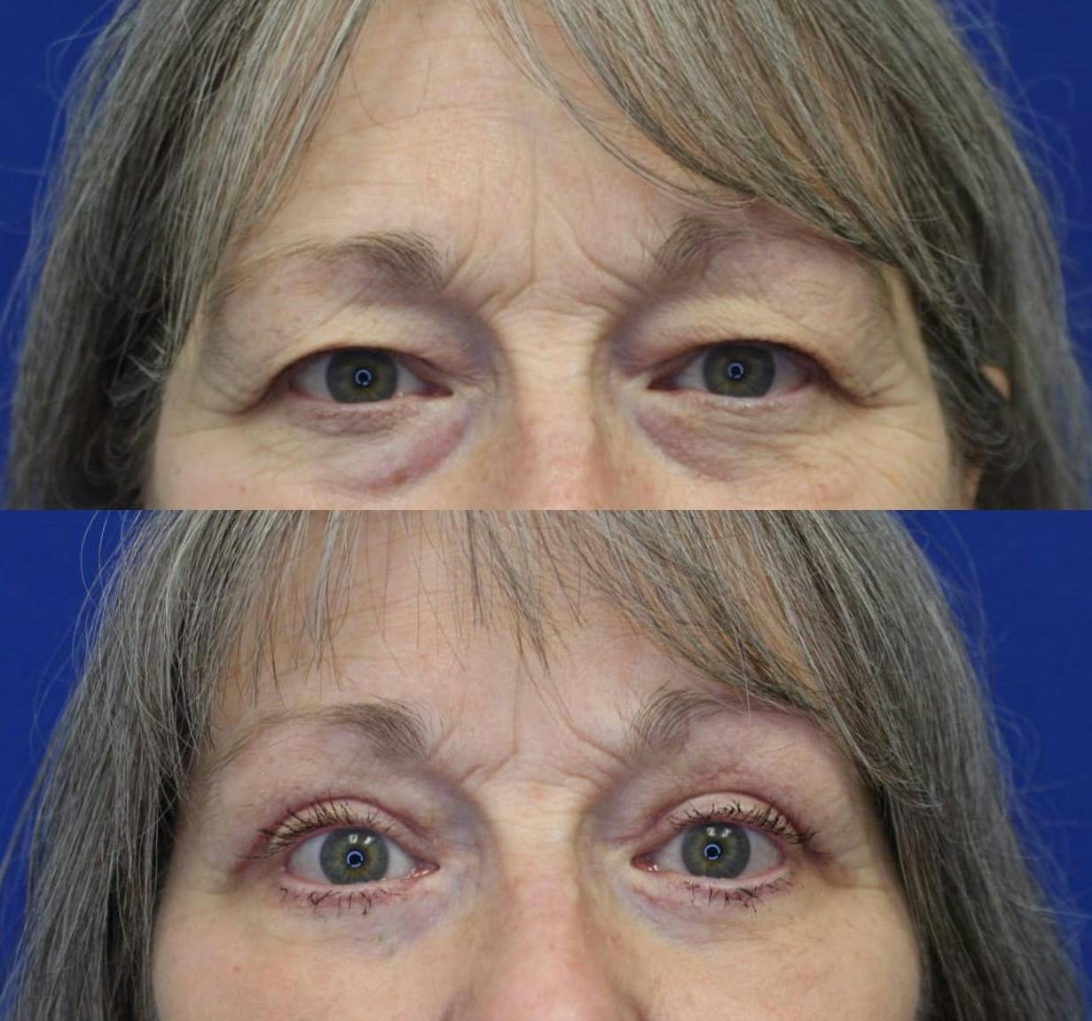 Lower Blepharoplasty Before & After Gallery - Patient 50776464 - Image 2