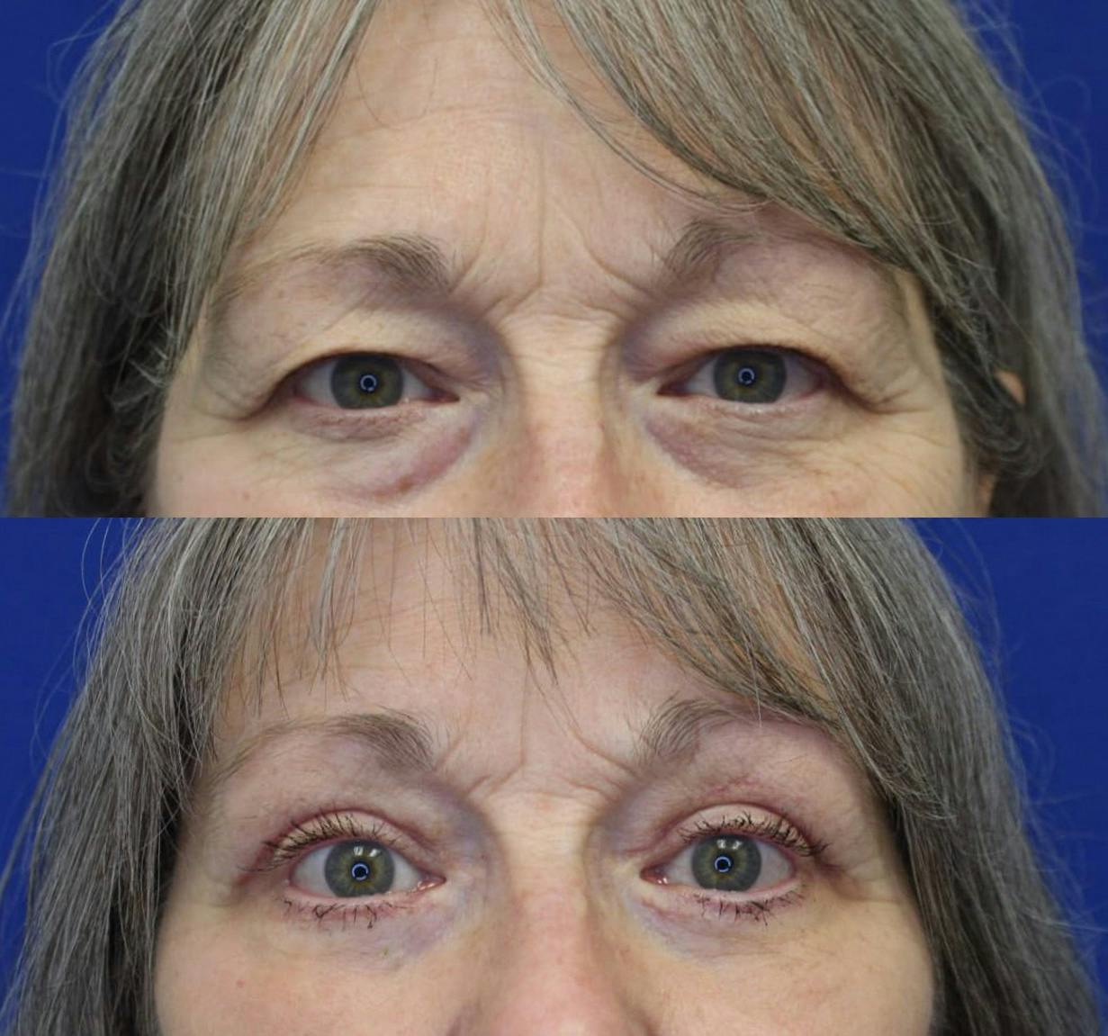 Upper Blepharoplasty Before & After Gallery - Patient 48152355 - Image 2