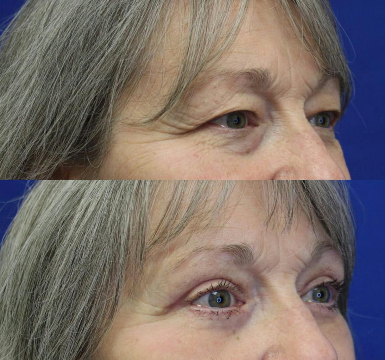 Upper Blepharoplasty Before & After Gallery - Patient 48152355 - Image 3