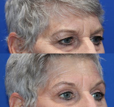 Upper Blepharoplasty Before & After Gallery - Patient 123725303 - Image 1