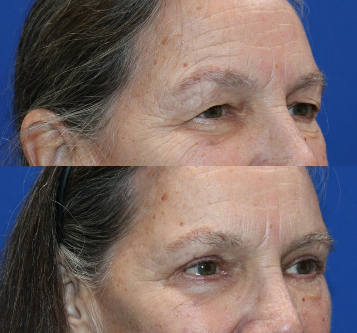 Upper Blepharoplasty Before & After Gallery - Patient 133237170 - Image 1