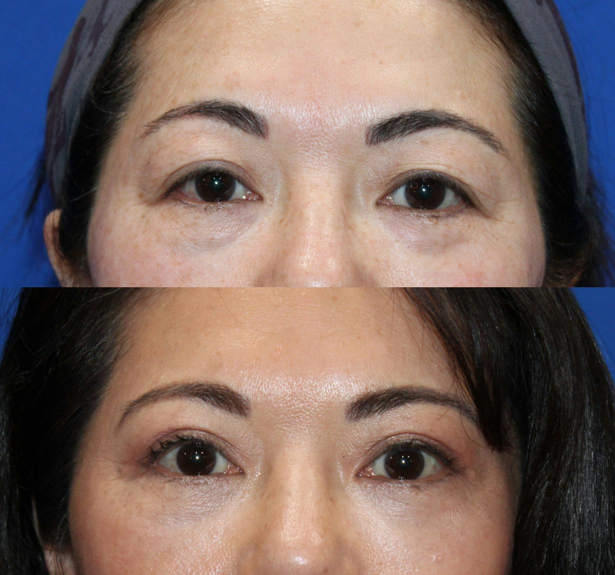 Upper Blepharoplasty Before & After Gallery - Patient 133474608 - Image 1