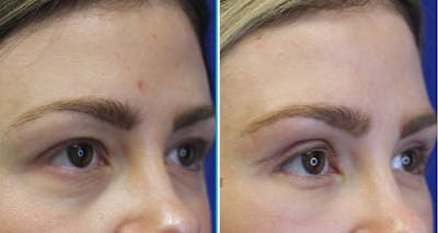 Lower Blepharoplasty Before & After Gallery - Patient 58188065 - Image 1