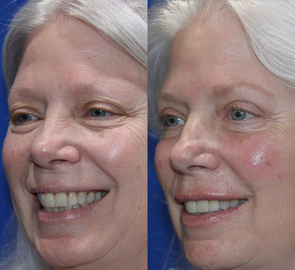 Chemical Peel Before and After Left Side Angle