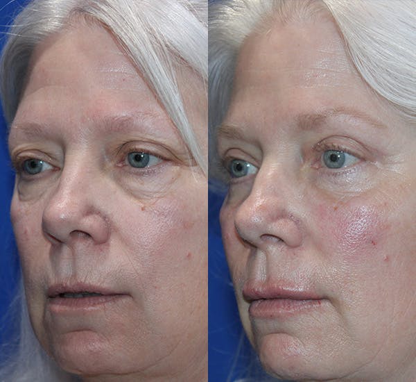 Chemical Peel Procedure