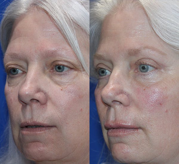 Full Circle Before & After Gallery - Patient 167602928 - Image 3