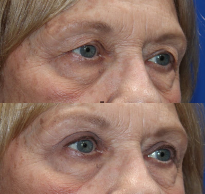 Upper Blepharoplasty Before & After Gallery - Patient 184187447 - Image 1
