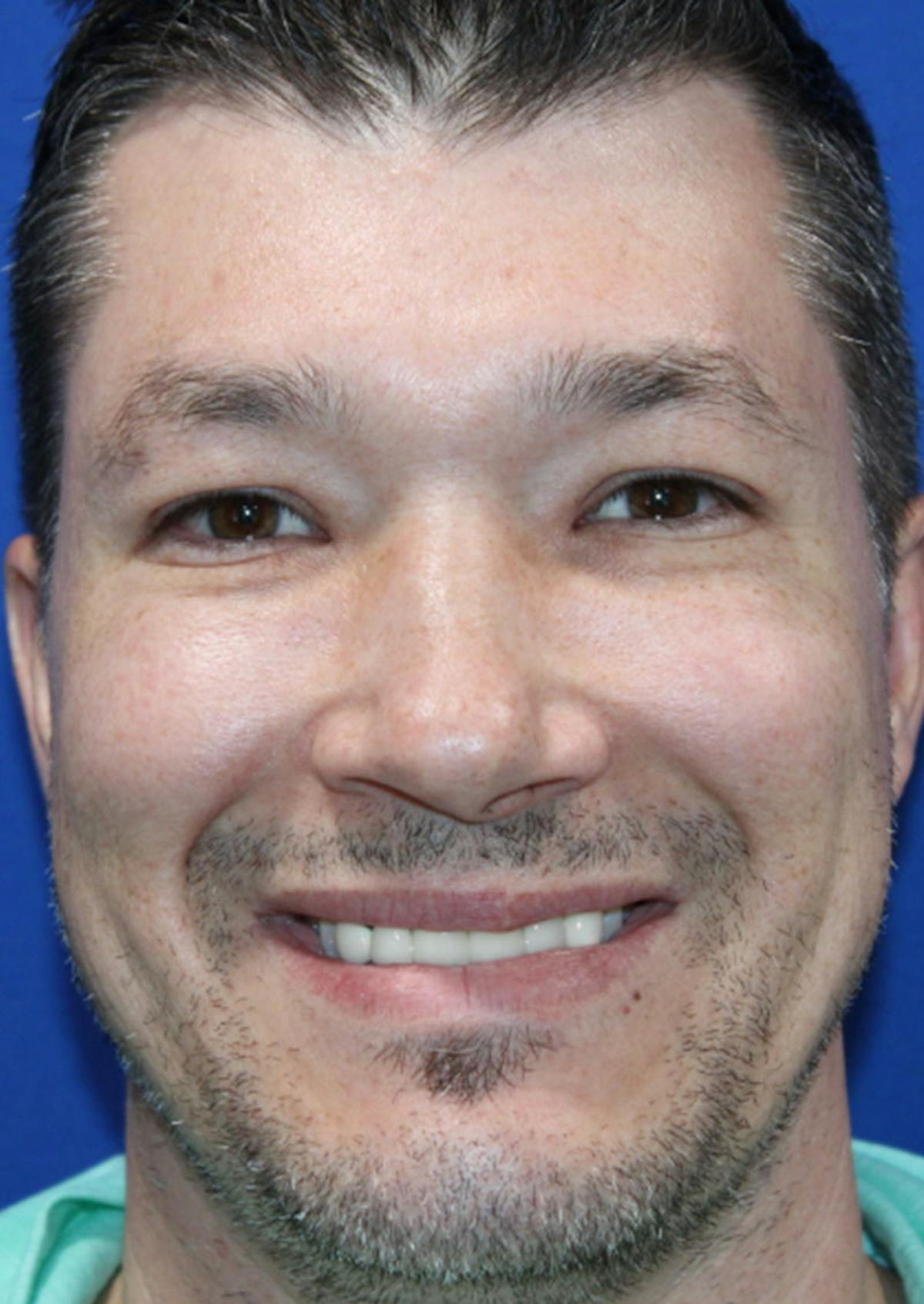 Nonsurgical Rejuvenation Before & After Gallery - Patient 184187518 - Image 4