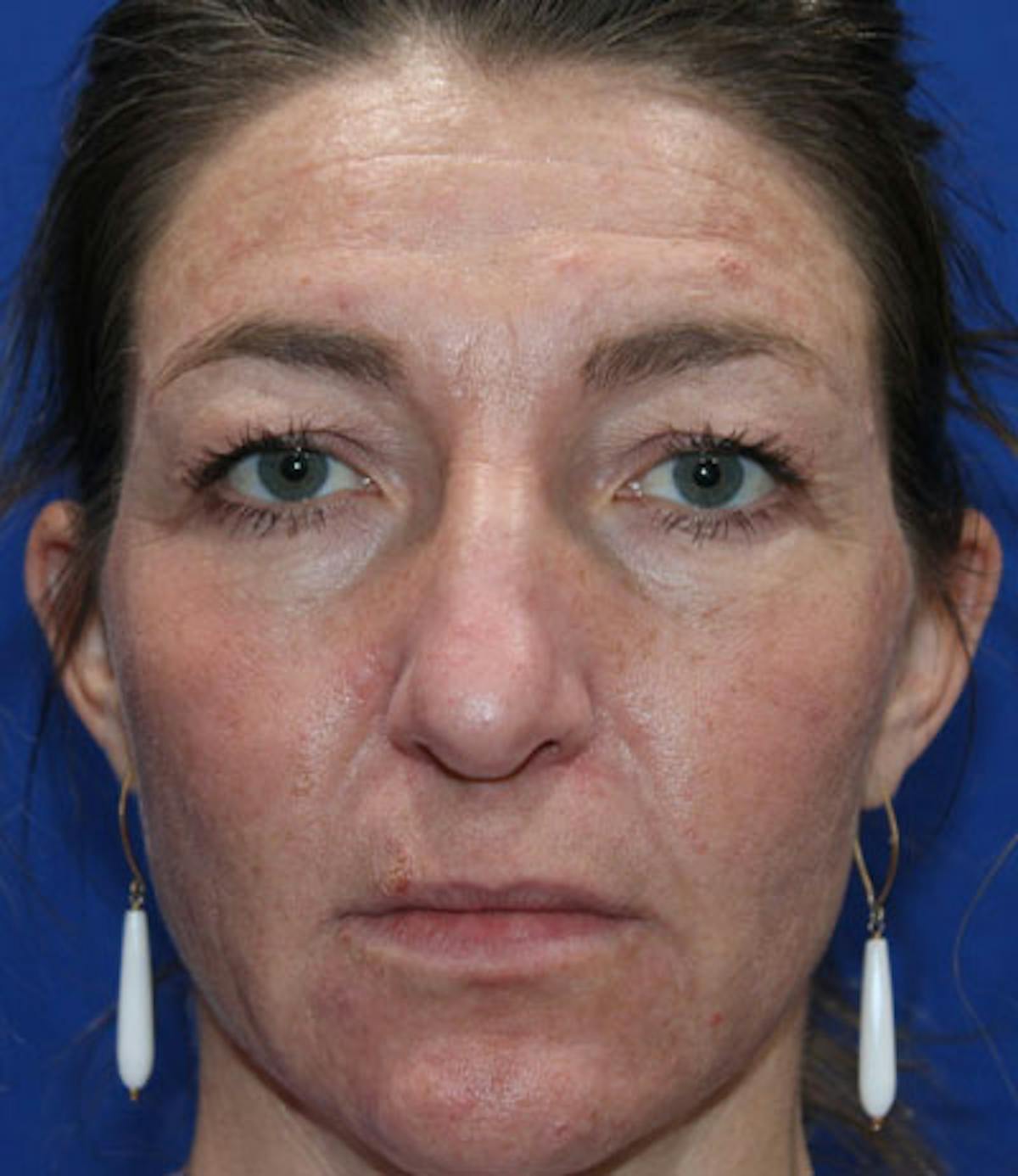Upper Blepharoplasty Before & After Gallery - Patient 165384803 - Image 1