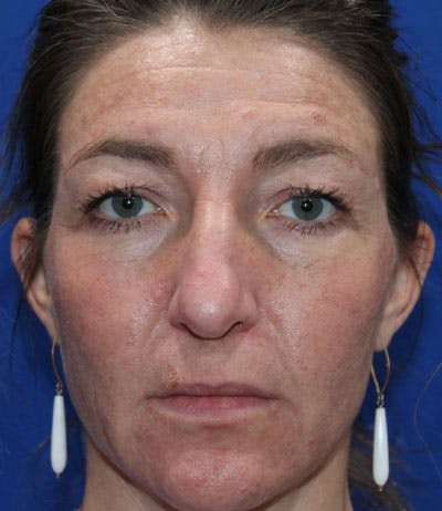 Upper Blepharoplasty Before & After Gallery - Patient 165384803 - Image 1