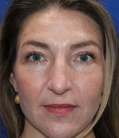 Upper Blepharoplasty Before & After Gallery - Patient 165384803 - Image 2