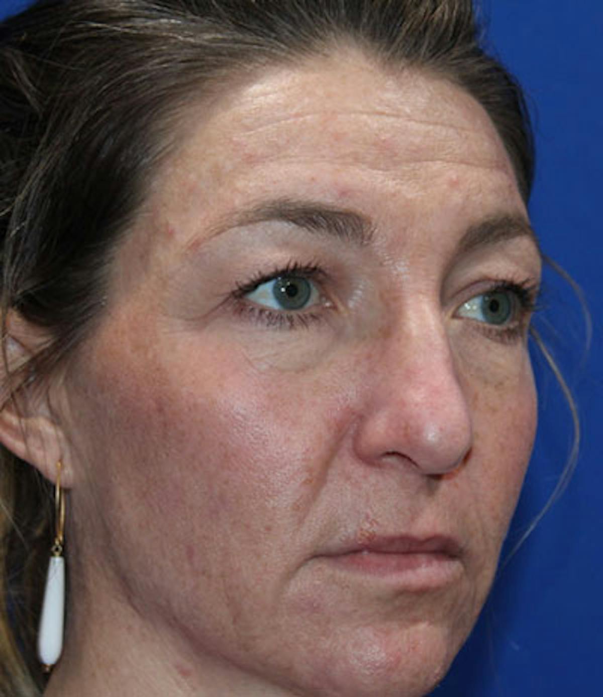 Upper Blepharoplasty Before & After Gallery - Patient 165384803 - Image 3