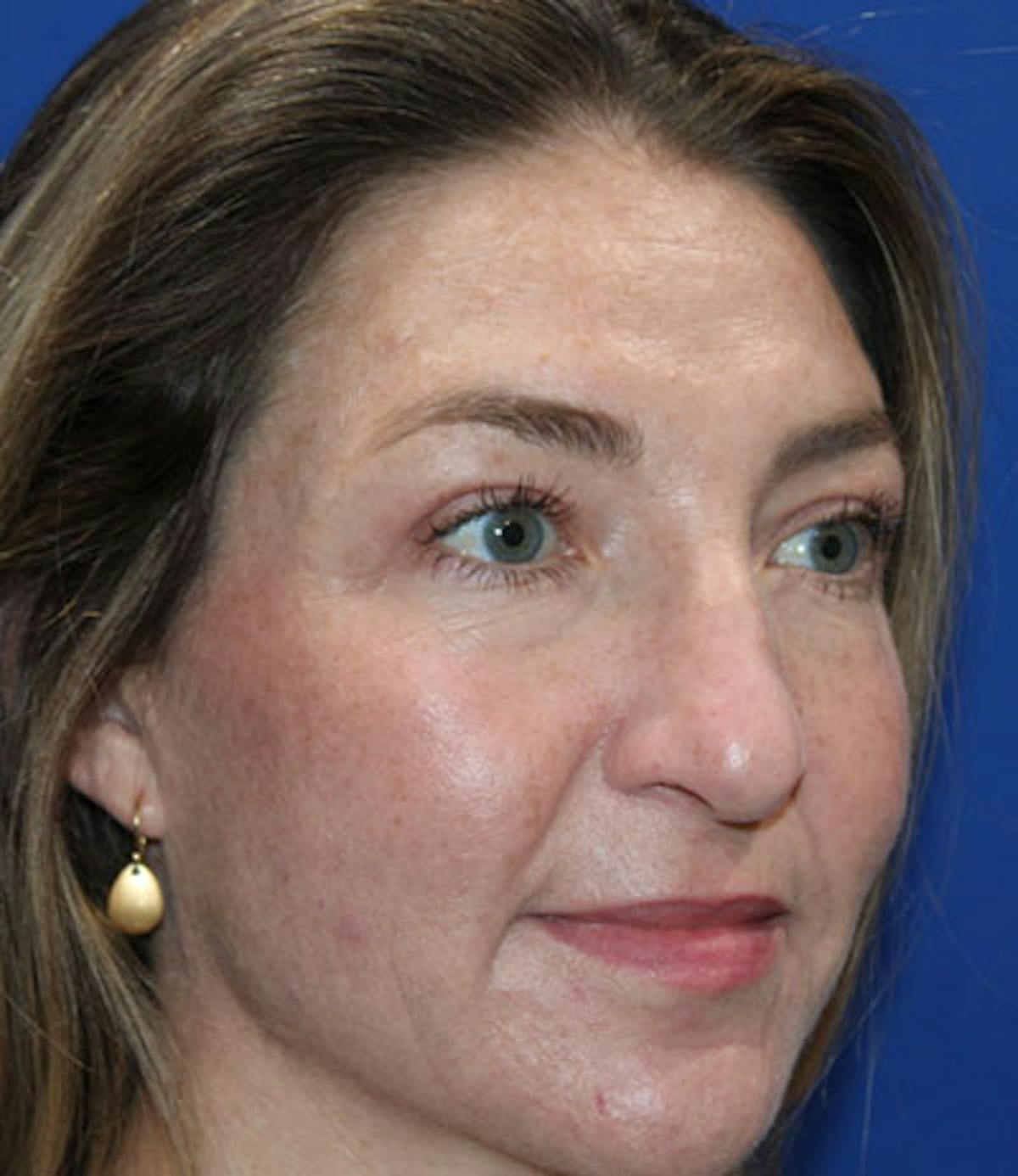 Upper Blepharoplasty Before & After Gallery - Patient 165384803 - Image 4