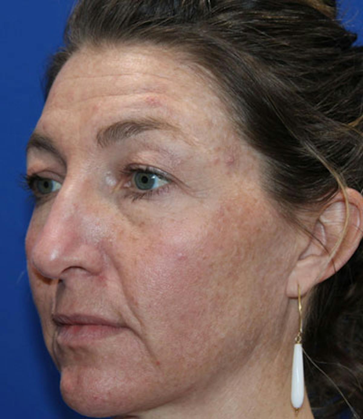Upper Blepharoplasty Before & After Gallery - Patient 165384803 - Image 5