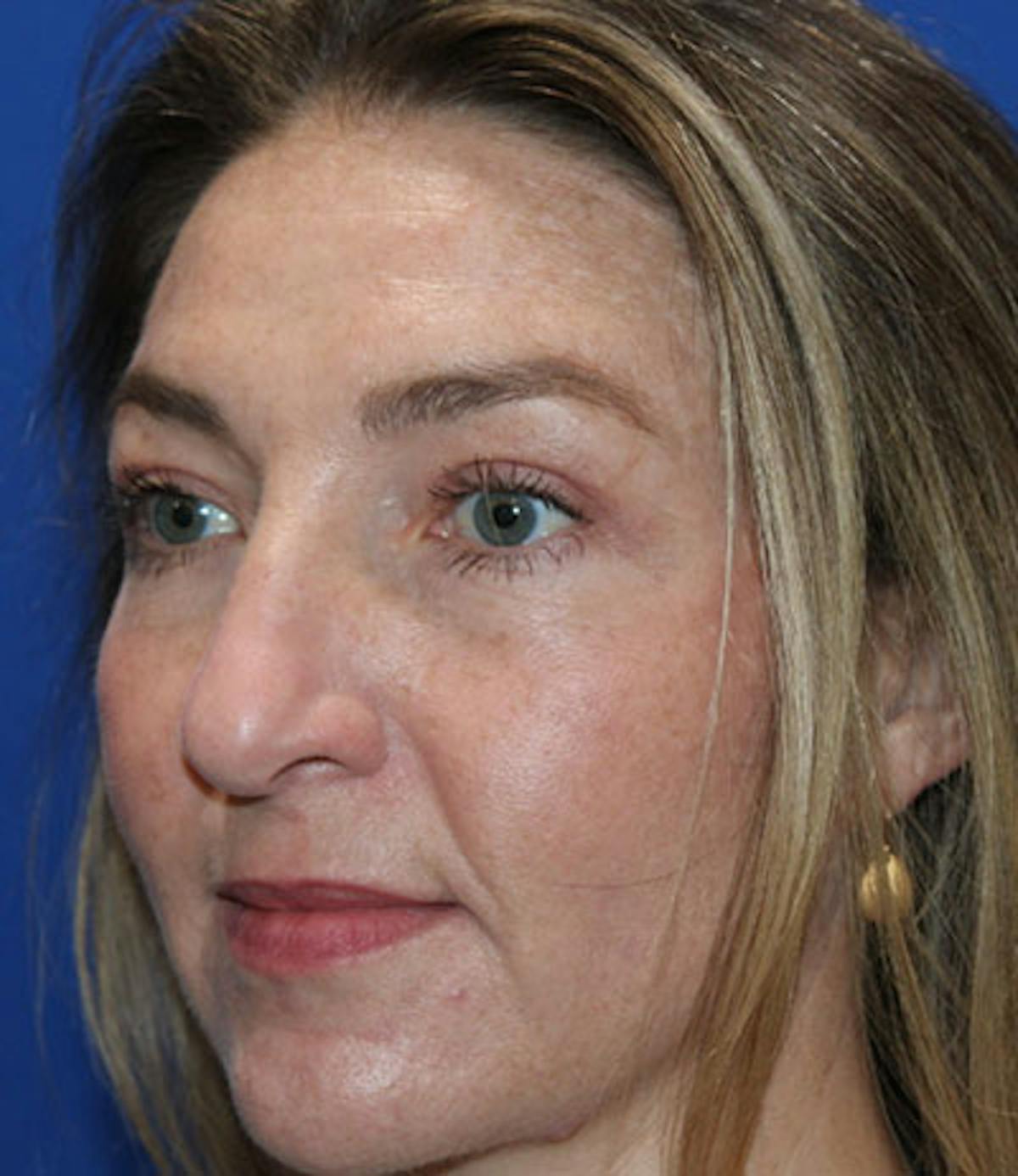 Upper Blepharoplasty Before & After Gallery - Patient 165384803 - Image 6