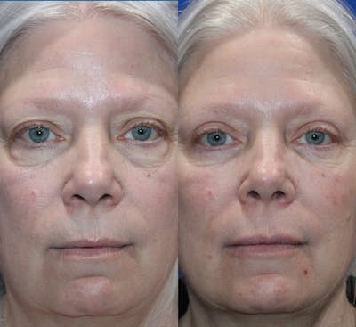 Full Circle Before & After Gallery - Patient 167602928 - Image 1