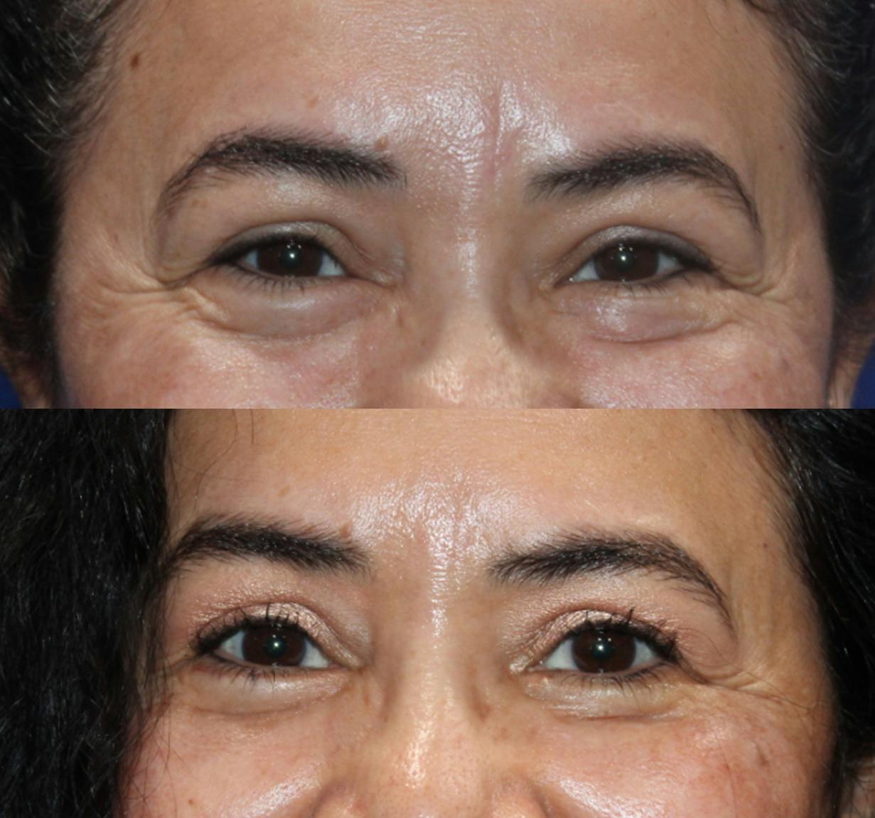 Lower Blepharoplasty Before & After Gallery - Patient 189119459 - Image 1