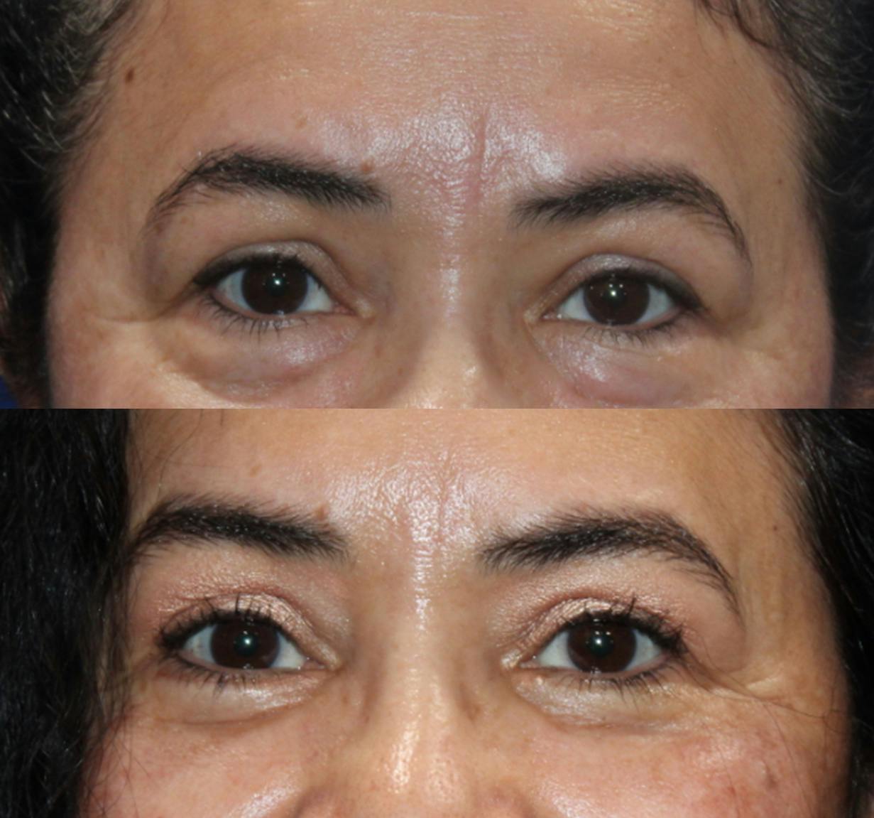 Lower Blepharoplasty Before & After Gallery - Patient 189119459 - Image 2