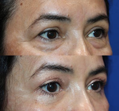 Lower Blepharoplasty Before & After Gallery - Patient 189119459 - Image 1