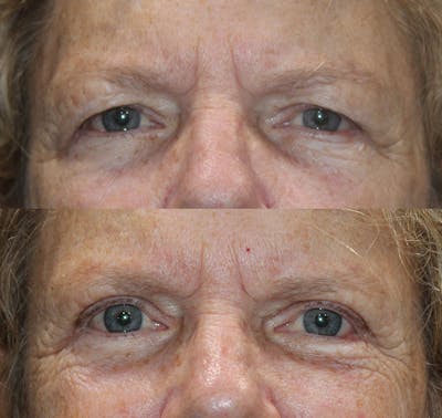 Upper Blepharoplasty Before & After Gallery - Patient 193668099 - Image 1