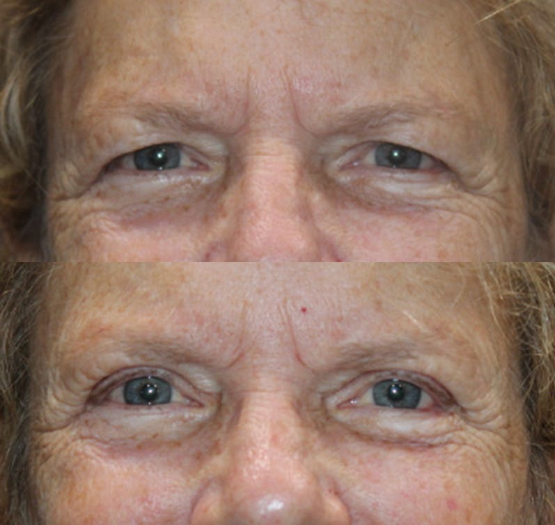 Upper Blepharoplasty Before & After Gallery - Patient 193668099 - Image 2