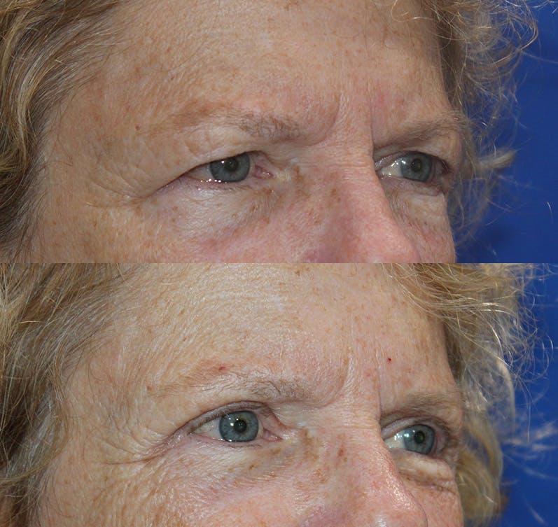 Upper Blepharoplasty Before & After Gallery - Patient 193668099 - Image 3