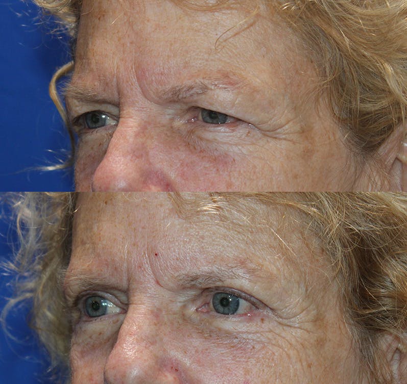 Upper Blepharoplasty Before & After Gallery - Patient 193668099 - Image 4