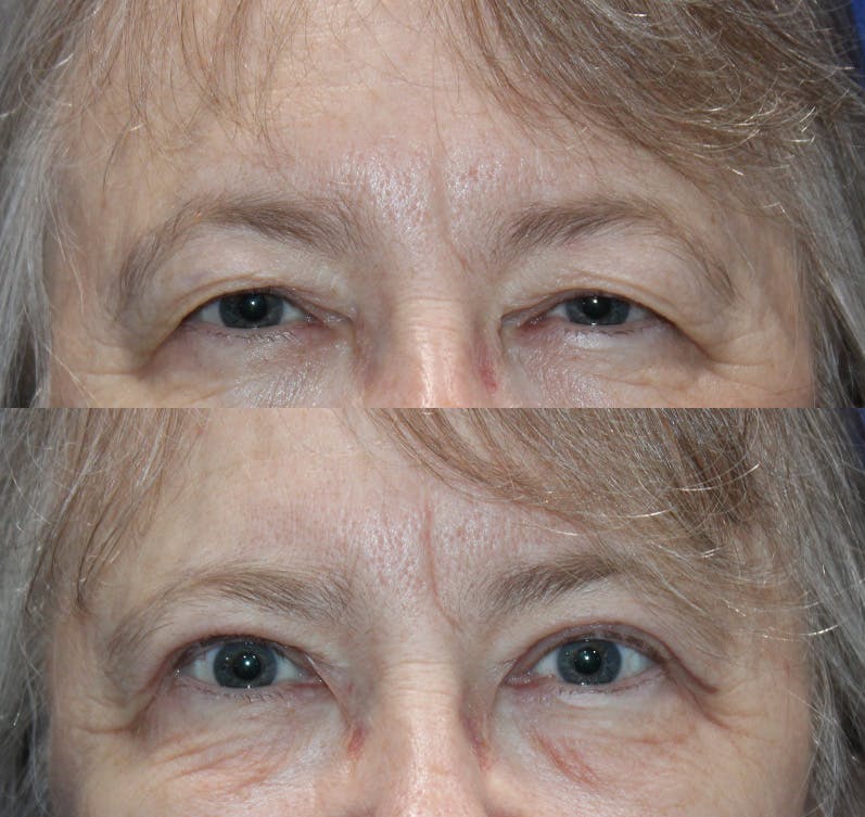 Upper Blepharoplasty Before & After Gallery - Patient 193921702 - Image 1